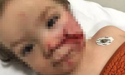 Pitbull çocuğun yüzünü parçaladı