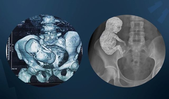 Kadının karnından 40 yıllık 'taş bebek' çıktı