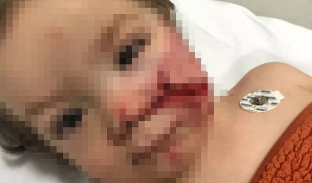 Pitbull çocuğun yüzünü parçaladı