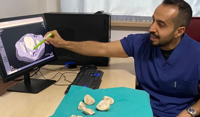 Diyarbakır’da doktorları şaşırtan görüntü: Yarım kilo ağırlığında 6 taş çıktı