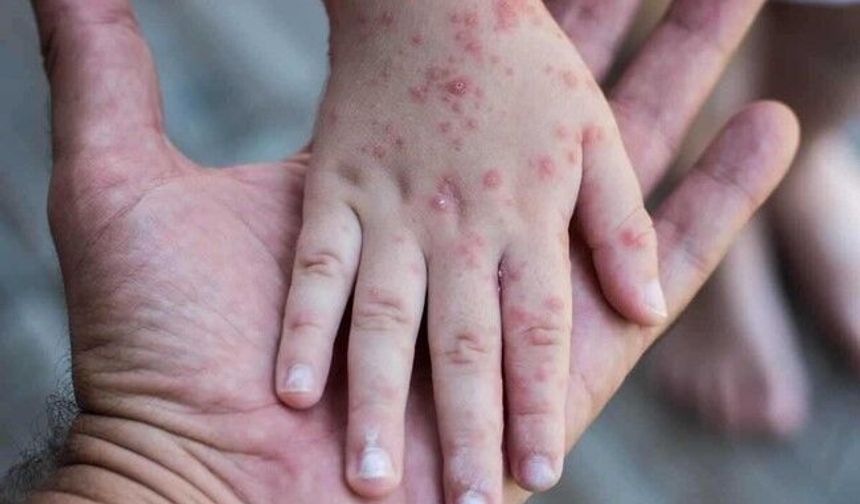 Kızamık vakaları pandemi öncesini geçti