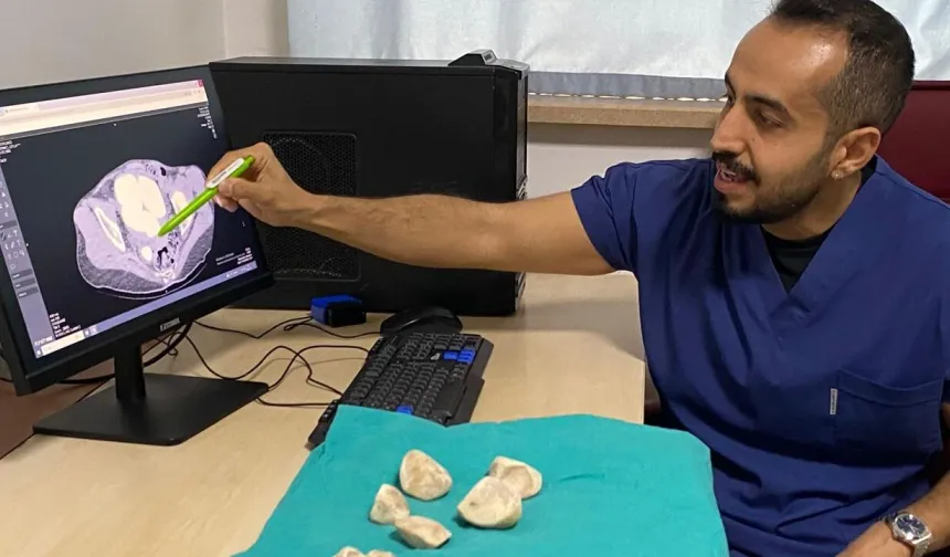 Diyarbakır’da doktorları şaşırtan görüntü: Yarım kilo ağırlığında 6 taş çıktı